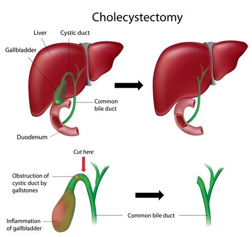 Cholecystectomy