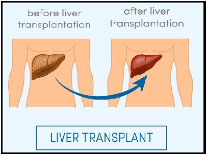 liver transplantation in pune