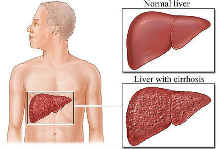 Liver Transplantation in pune