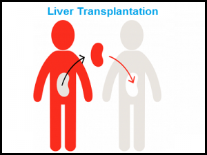 liver transplantation in pune