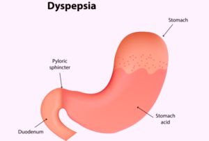 Dyspepsia 
